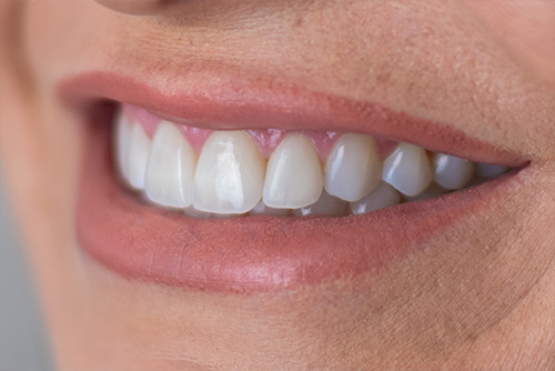 Lentes de Contato Dental: Melhorias para os dentes que vão além da estética.