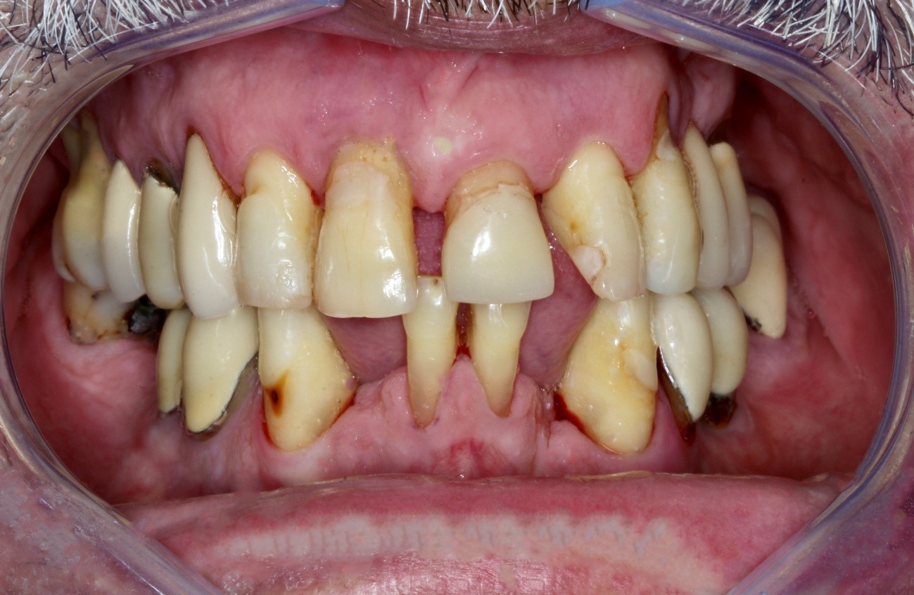 O que é a bolsa periodontal?