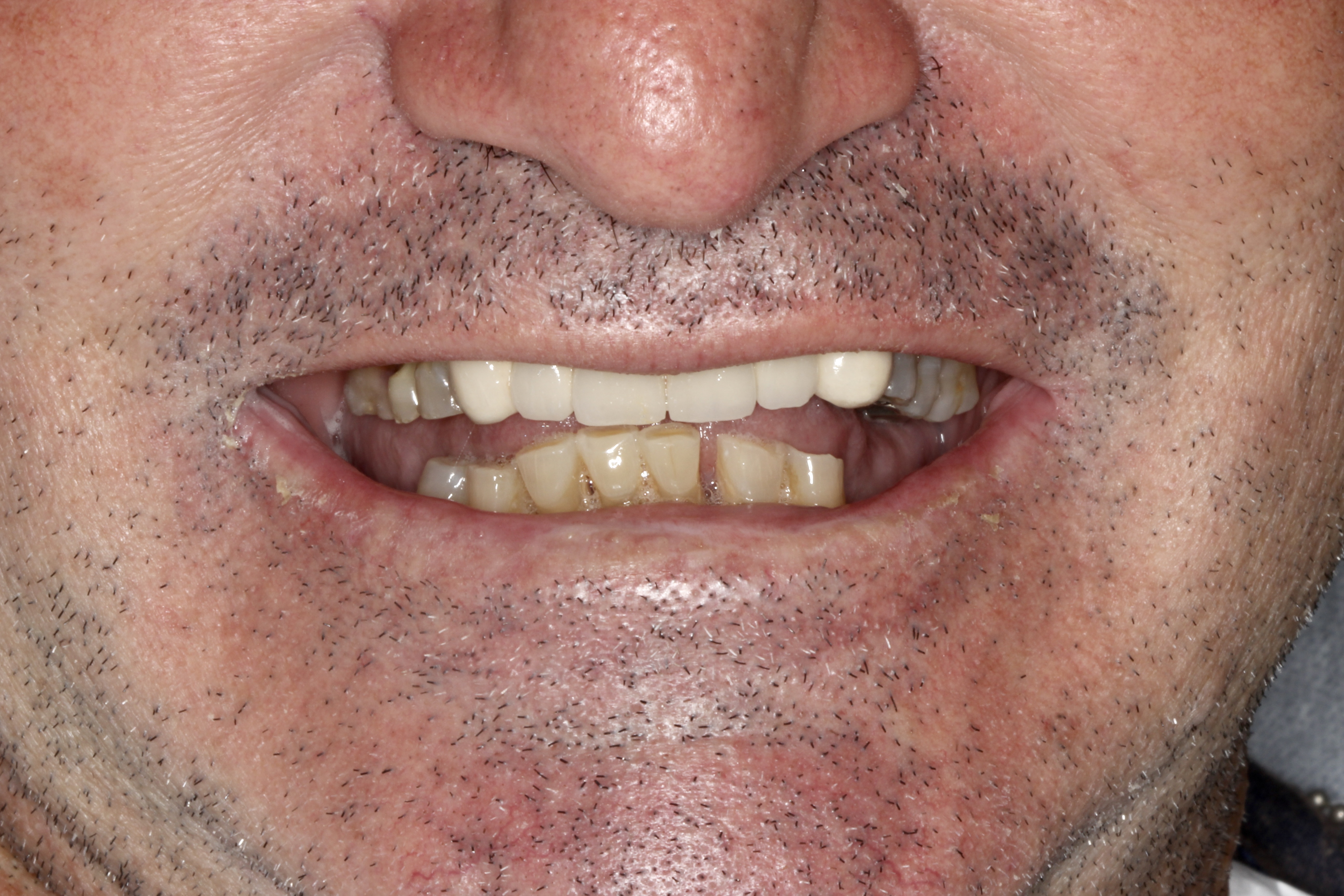 Erosão dentária: você sabe o que é?