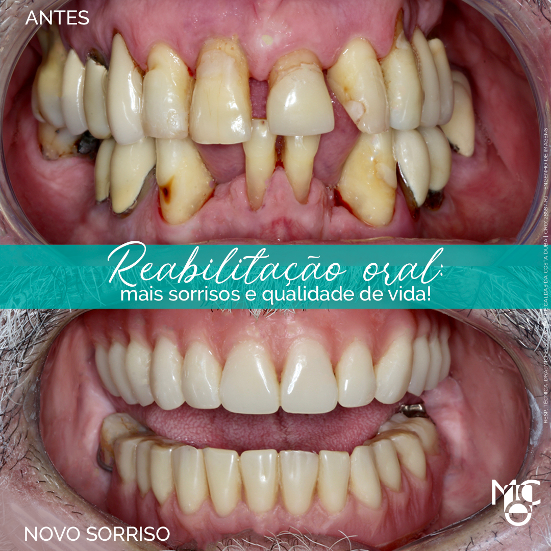 Reabilitação oral: mais sorrisos e qualidade de vida